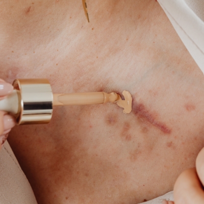 Comment se débarrasser de ses cicatrices ?